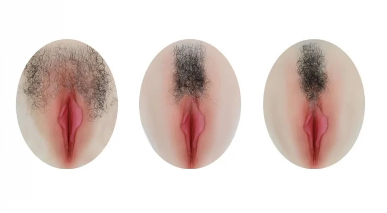 she-pubichair-transplant
